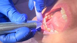 dental laser dental laser