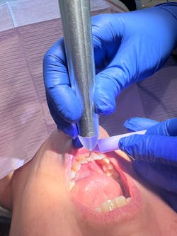 dental laser dental laser