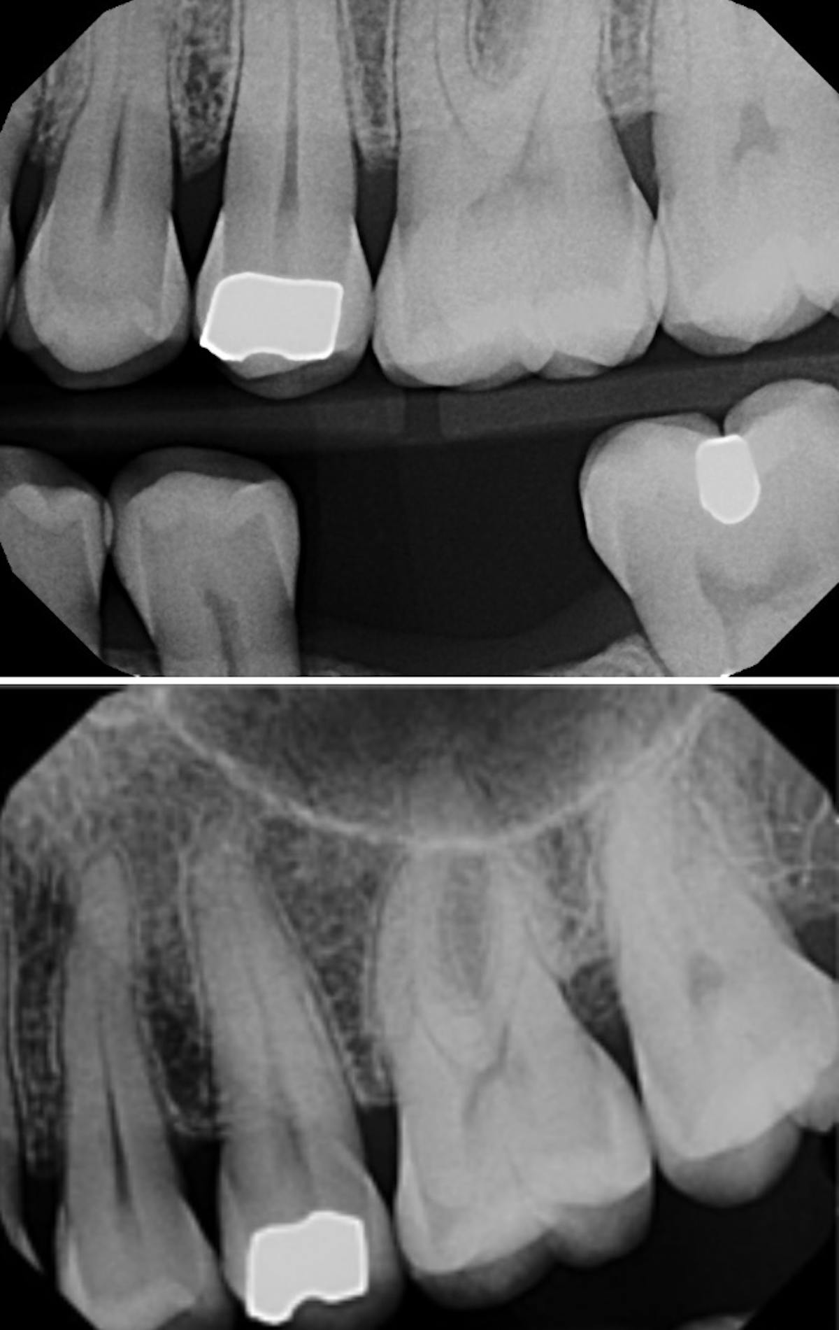 Dental insurance claim reimbursement Radiographs and narratives for