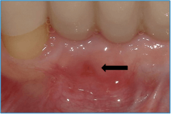 Patient presents with a gingival fenestration persisting 10 months after extraction.