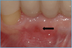 Patient presents with a gingival fenestration persisting 10 months after extraction. Patient presents with a gingival fenestration persisting 10 months after extraction.