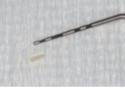 Cotton pliers remove a bone sequestrum measuring 1 mm x 3 mm. Cotton pliers remove a bone sequestrum measuring 1 mm x 3 mm.