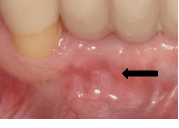 Tissue closure two months later Tissue closure two months later