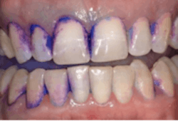 A cotton ball was used to disclose the patient&rsquo;s right side of the mouth. A cotton-tip applicator was used for the left side of the mouth. The cotton ball demonstrates fuller coverage.