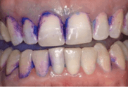 A cotton ball was used to disclose the patient’s right side of the mouth. A cotton-tip applicator was used for the left side of the mouth. The cotton ball demonstrates fuller coverage. A cotton ball was used to disclose the patient’s right side of the mouth. A cotton-tip applicator was used for the left side of the mouth. The cotton ball demonstrates fuller coverage.