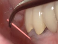 A fistula threaded A fistula threaded