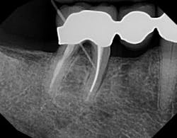 The radiograph with gutta percha threaded