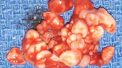 Compound odontoma