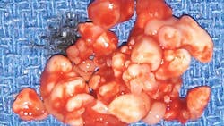 Compound odontoma Compound odontoma