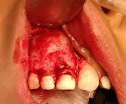 Figure 3: Cortical expansion Figure 3: Cortical expansion