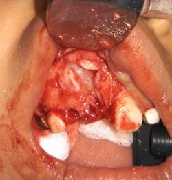 Figure 4: Postenucleation Figure 4: Postenucleation