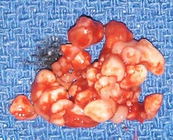 Figure 5: Compound odontoma Figure 5: Compound odontoma