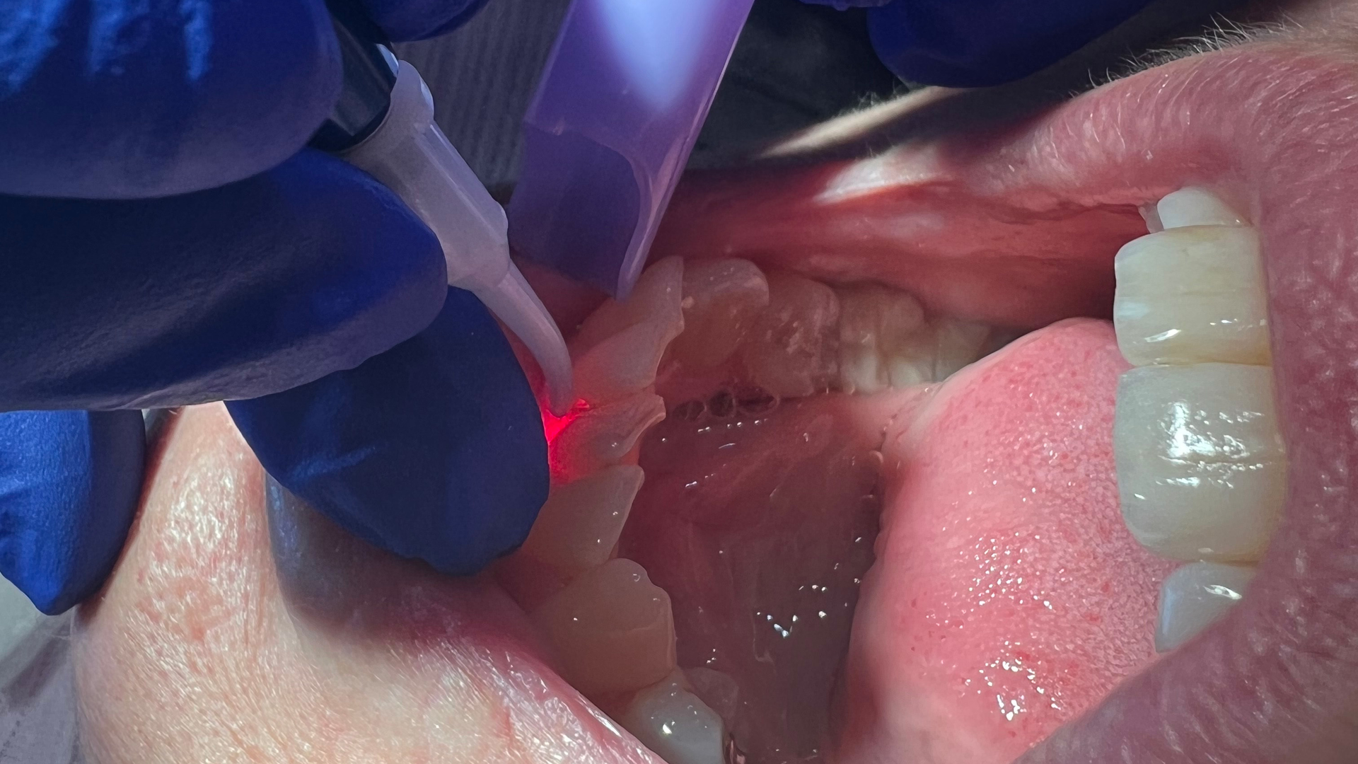 Dental lasers will last a long time if they are cared for properly.