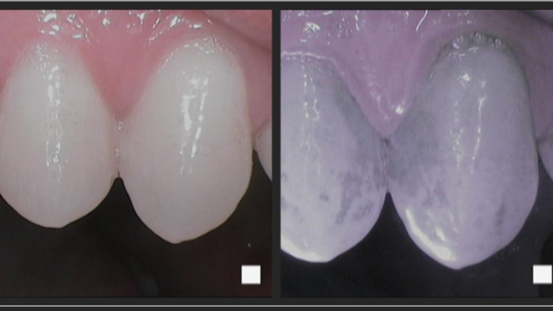 Lumorinse is a green, photosensitive mouthwash that is swished in the mouth before application of the Lumoral light. Near-infrared imaging shows that even the best toothbrushing leaves a lot of residual plaque.