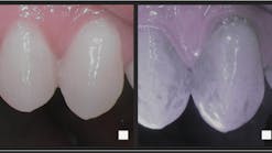 Lumorinse is a green, photosensitive mouthwash that is swished in the mouth before application of the Lumoral light. Near-infrared imaging shows that even the best toothbrushing leaves a lot of residual plaque.