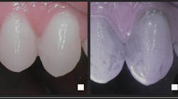 Lumorinse is a green, photosensitive mouthwash that is swished in the mouth before application of the Lumoral light. Near-infrared imaging shows that even the best toothbrushing leaves a lot of residual plaque. Lumorinse is a green, photosensitive mouthwash that is swished in the mouth before application of the Lumoral light. Near-infrared imaging shows that even the best toothbrushing leaves a lot of residual plaque.