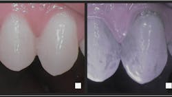 Lumorinse is a green, photosensitive mouthwash that is swished in the mouth before application of the Lumoral light. Near-infrared imaging shows that even the best toothbrushing leaves a lot of residual plaque. Lumorinse is a green, photosensitive mouthwash that is swished in the mouth before application of the Lumoral light. Near-infrared imaging shows that even the best toothbrushing leaves a lot of residual plaque.
