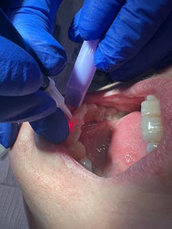 Dental lasers will last a long time if they are cared for properly. Dental lasers will last a long time if they are cared for properly.