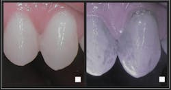 Left: Teeth just after brushing in natural light. Right: After swishing with Lumorinse mouth rinse; Lumorinse attaches to plaque bacteria. Lumorinse is a green, photosensitive mouthwash that is swished in the mouth before application of the Lumoral light. Near-infrared imaging shows that even the best toothbrushing leaves a lot of residual plaque. Left: Teeth just after brushing in natural light. Right: After swishing with Lumorinse mouth rinse; Lumorinse attaches to plaque bacteria. Lumorinse is a green, photosensitive mouthwash that is swished in the mouth before application of the Lumoral light. Near-infrared imaging shows that even the best toothbrushing leaves a lot of residual plaque.
