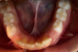 Figure 1: “Eiffel tower” appearance of tongue Figure 1: “Eiffel tower” appearance of tongue