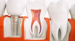 cost-dental-implant