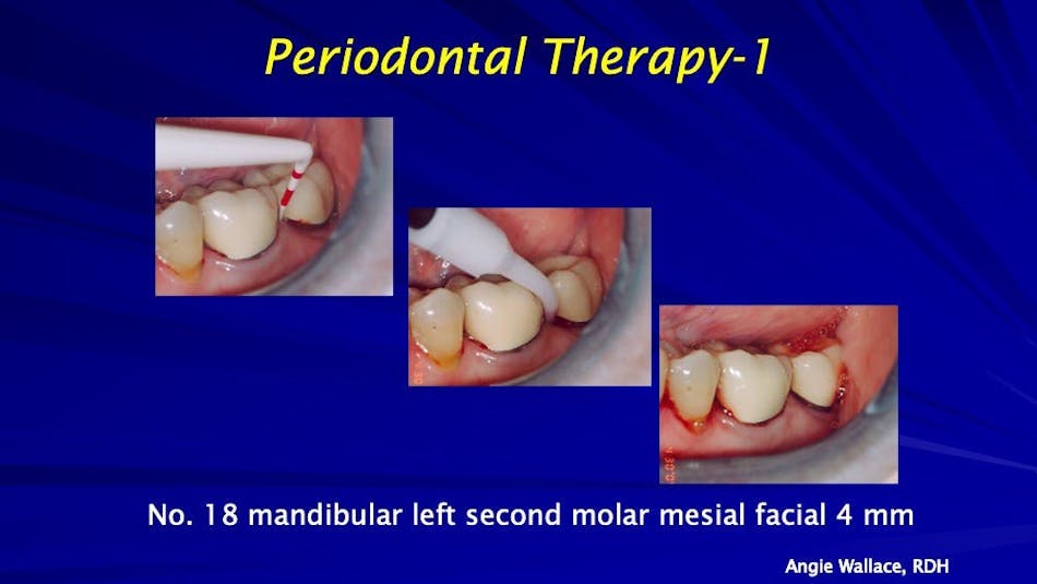 Laserassisted treatment of periodontal disease A case study Dentistry IQ