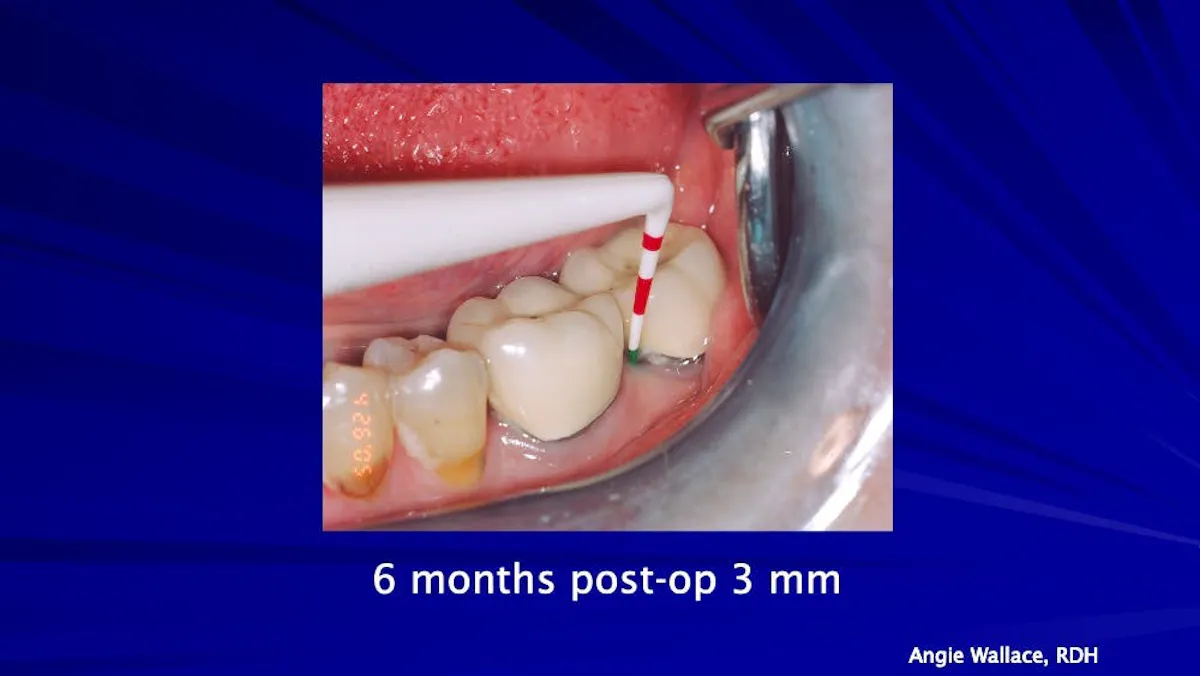 Laser-assisted treatment of periodontal disease: A case study ...