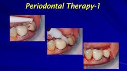 periodontal-therapy-laser-case-study