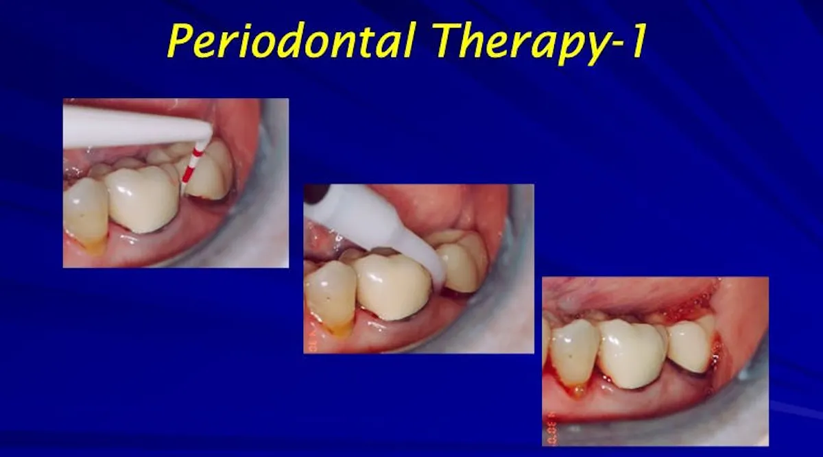 Laser-assisted treatment of periodontal disease: A case study ...
