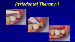 659449f5fd5dd2001f062617 Primaryperiodontaltherapy 659449f5fd5dd2001f062617 Primaryperiodontaltherapy