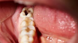 dear-patient-cavities dear-patient-cavities