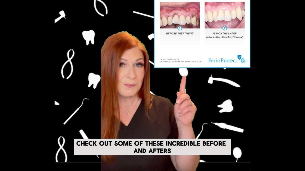 When perio patients only want whiter teeth