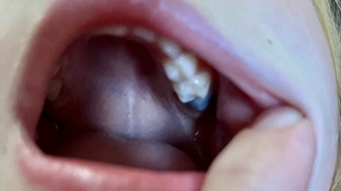 65d3cb14177704001ef6fbc0 Eruptioncyst