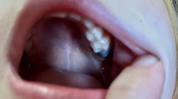 eruption-cyst-dentistry eruption-cyst-dentistry