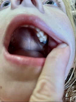eruption-cyst-dental eruption-cyst-dental