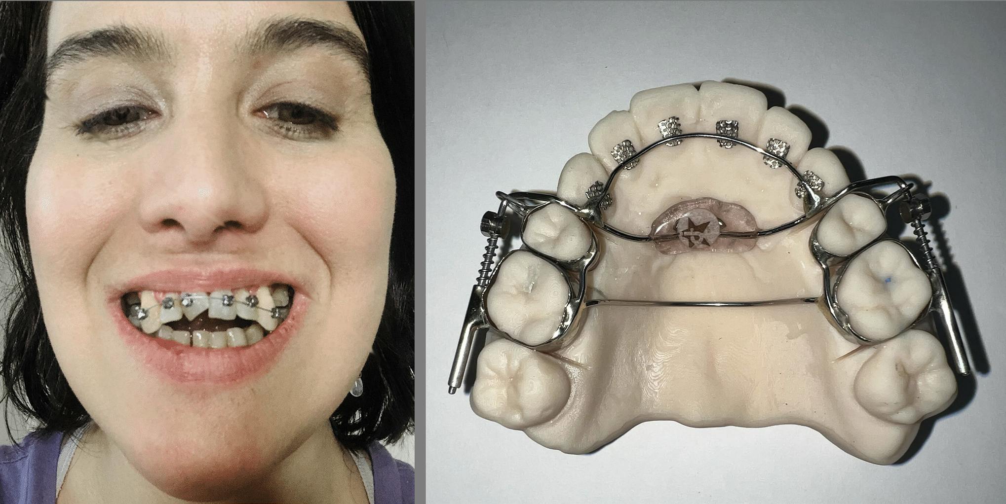 Person wearing braces