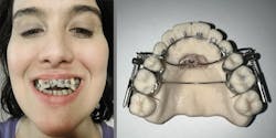 Person wearing braces