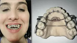 Person wearing braces