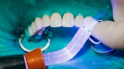 Person getting veneers Person getting veneers