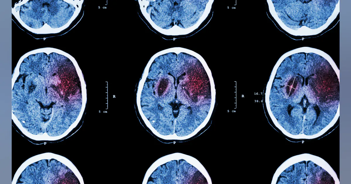 The correlation between gum disease and stroke risk exposed: A wake-up call The correlation between gum disease and stroke risk exposed: A wake-up call