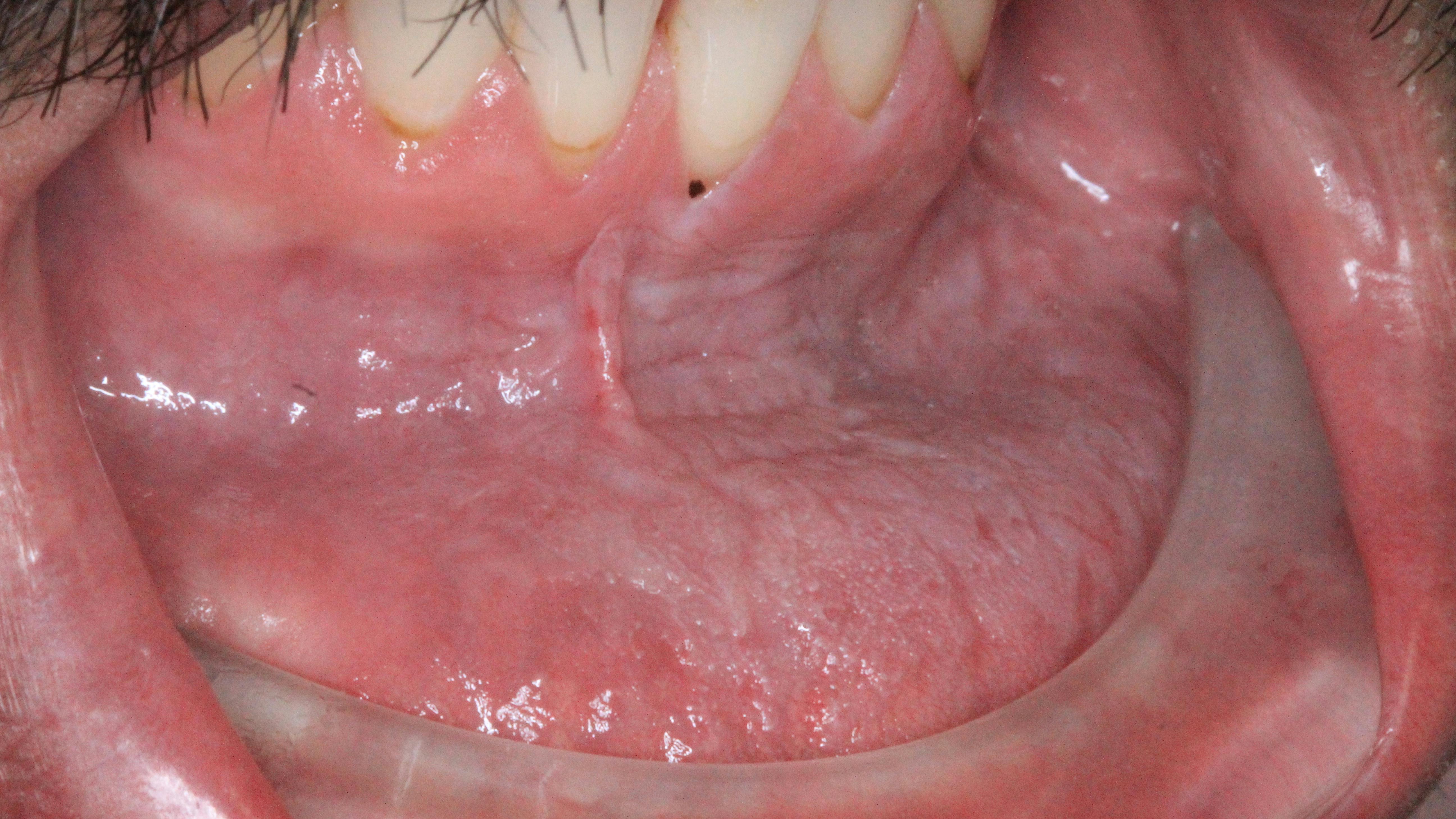 pathology of a chronic tobacco user