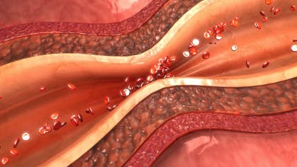 Management of dental patients with coronary vasospasm