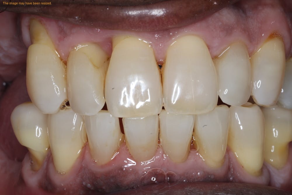The clinical benefits of periodontal desiccation | Dentistry IQ