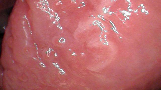 66c781a61e4f64b66a7d70ab Tongue Lesion 3