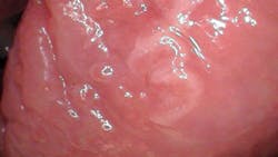 66c781a61e4f64b66a7d70ab Tongue Lesion 3 66c781a61e4f64b66a7d70ab Tongue Lesion 3