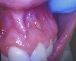 Seven asymptomatic, well-defined, fluid-filled lesions ranging in size from 2 mm to 5 mm were found in a 17-year-old male patient on the vestibular mucosa (nos. 7–10). The lesions were similar in color to the surrounding mucosa, had a smooth surface, and were nontender to palpation. Seven asymptomatic, well-defined, fluid-filled lesions ranging in size from 2 mm to 5 mm were found in a 17-year-old male patient on the vestibular mucosa (nos. 7–10). The lesions were similar in color to the surrounding mucosa, had a smooth surface, and were nontender to palpation.