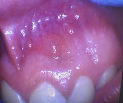 Seven asymptomatic, well-defined, fluid-filled lesions ranging in size from 2 mm to 5 mm were found in a 17-year-old male patient on the vestibular mucosa (nos. 7–10). The lesions were similar in color to the surrounding mucosa, had a smooth surface, and were nontender to palpation. Seven asymptomatic, well-defined, fluid-filled lesions ranging in size from 2 mm to 5 mm were found in a 17-year-old male patient on the vestibular mucosa (nos. 7–10). The lesions were similar in color to the surrounding mucosa, had a smooth surface, and were nontender to palpation.