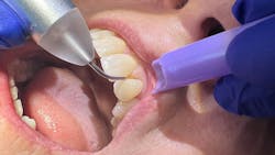 dental lasers dental lasers