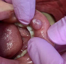 likely diagnosis is oral mucocele likely diagnosis is oral mucocele