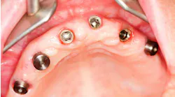 Dental implants Dental implants